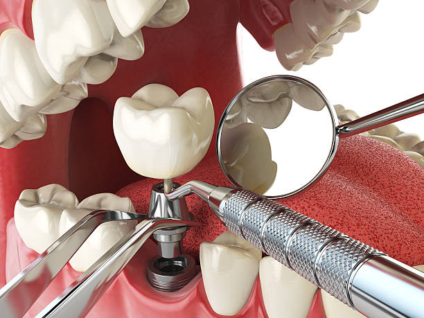 Best Emergency Dentist for Knocked-Out Tooth in Iron Mountain, MI