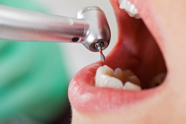 Best Emergency Dentist for Lost Fillings or Crowns in Iron Mountain, MI